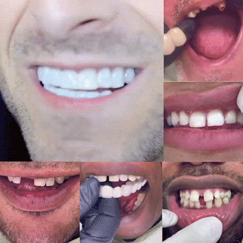 Carillas de Sonrisa Instantánea